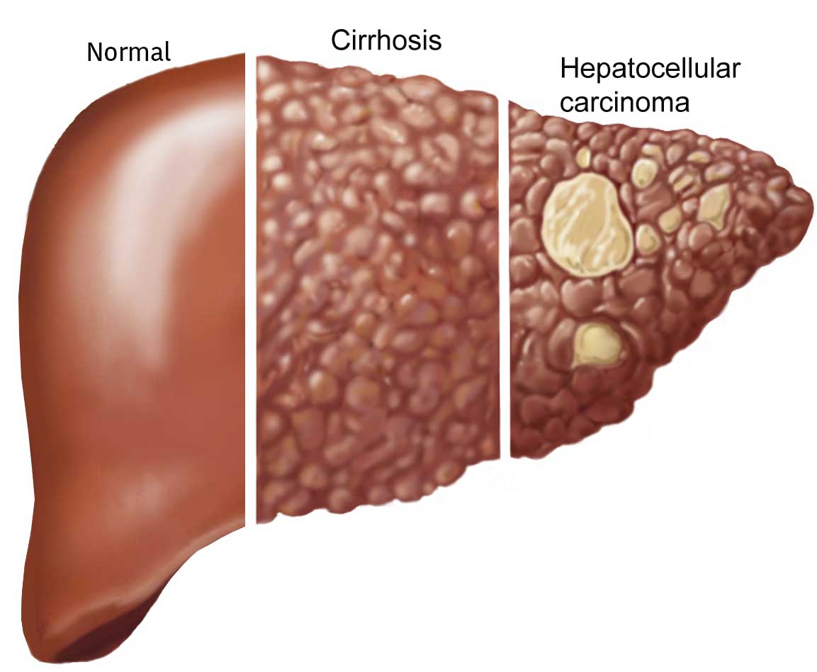 Can Liver Tumor Cause Back Pain at Leroy Griffith blog