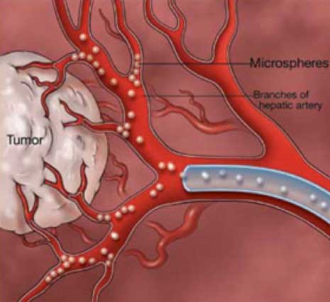 Liver Tumor Surgery